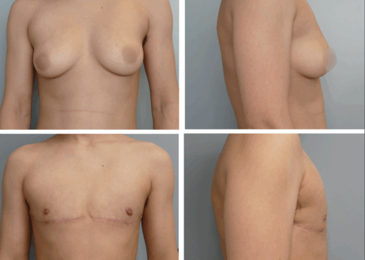 Top Surgery Portland Oregon Before and After by Dr. Tina Jenq